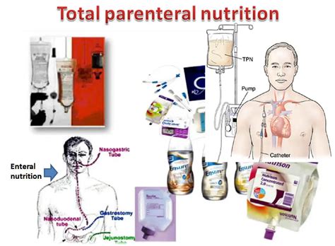Total parenteral nutrition .